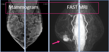 Mammogram vs FAST MRI image showing breast lump (on right) Mammogram vs FAST MRI image showing breast lump (on right)