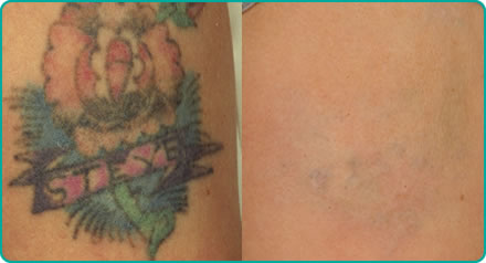 Tattoo Removal Before and After Reds