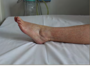 Ankle with toes pointed