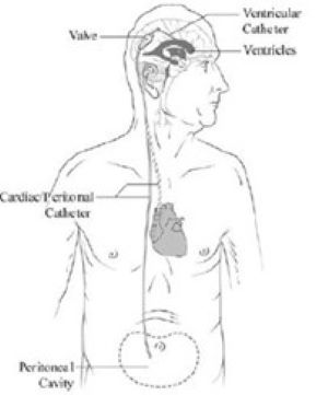 Diagram of person with CSF shunt going from ventricles of brain do drain the peritoneal cavity