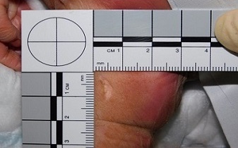 Fig 2 - Site of biopsy after removal of sample