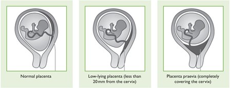 illustration of placenta praevia, placenta accreta, and vasa praevia 