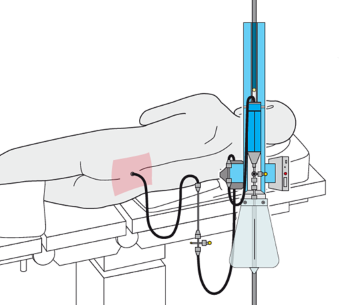 Diagram of person from behind, lying on side, with lumbar drain inserted into lower back