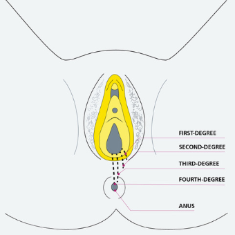 Illustration of the location of first, second, third and fourth degree obstetric anal sphincter injuries