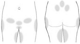 Diagram of areas where pregnancy-related pelvic girdle pain can happen