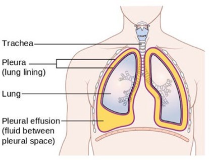 Diagram of chest indicating trachea, pleura (lung lining), lung, and pleural effusion