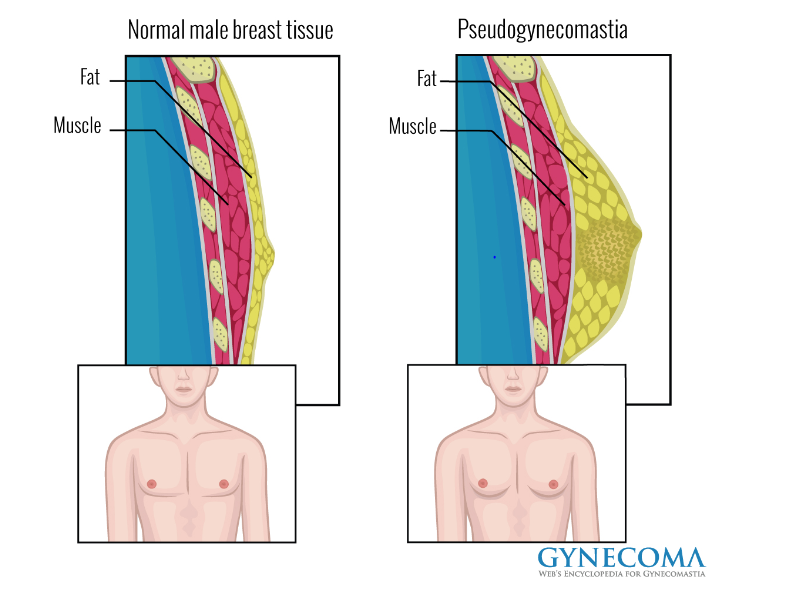 Causes of Male Breast Pain and Swelling